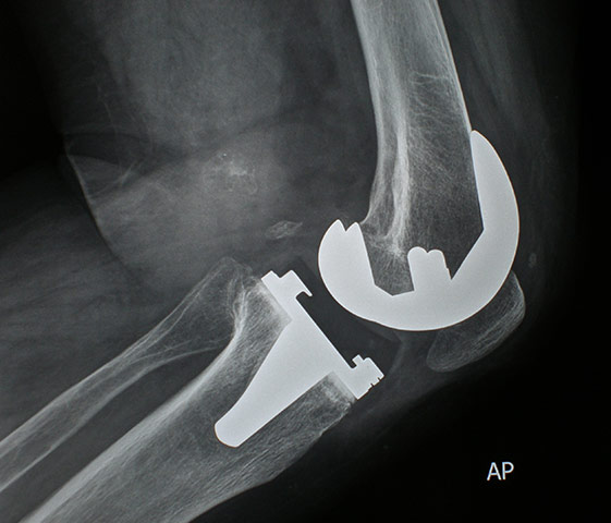 Knee replacement surgery