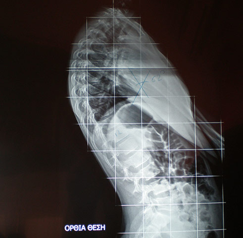 Thoracic Kyphosis