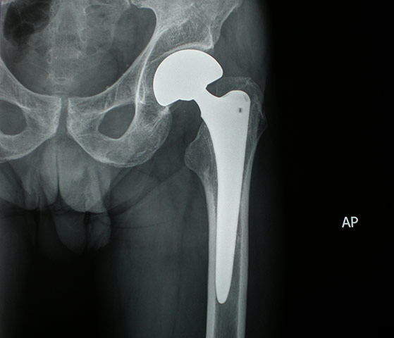 Hip replacement surgery