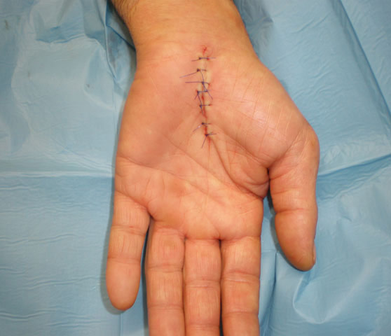 Carpal Tunnel Syndrome