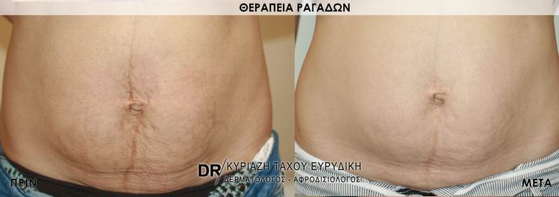 Θεραπεία ραγάδων