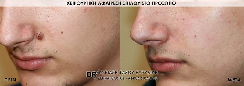 Χειρουργική αφαίρεση σπίλου στο πρόσωπο