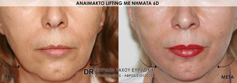 Αναίμακτο lifting με νήματα 6D