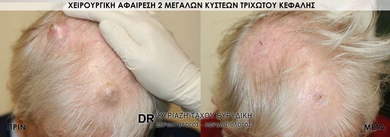 Χειρουργική αφαίρεση 2 μεγάλων κύστεων τριχωτού κεφάλης