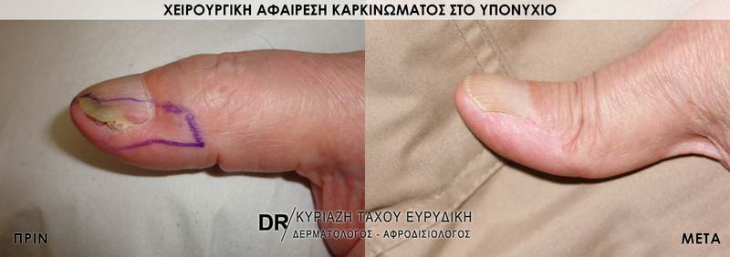 Χειρουργική αφαίρεση καρκινώματος στο υπονύχιο