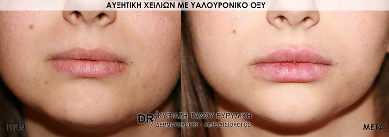 Αυξητική χειλιών με υαλουρονικό οξύ