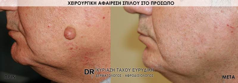 Χειρουργική αφαίρεση σπίλου στο πρόσωπο