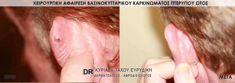 Χειρουργική αφαίρεση βασικοκυτταρικού καρκινώματος πτερυγίου