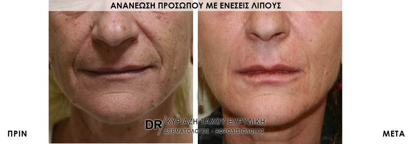 Ανανέωση προσώπου με ενέσεις λίπους