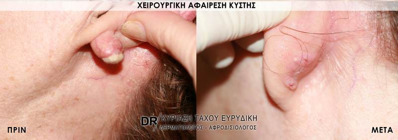 Χειρουργική αφαίρεση κύστης