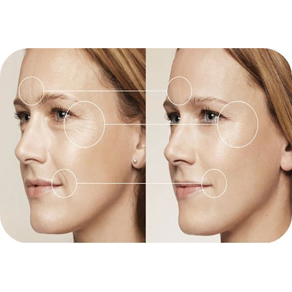 Botox