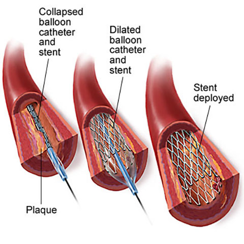 Occlusive Peripheral Arterial Disease