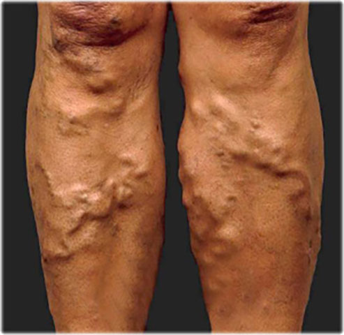 Varicose Veins in the Extremities