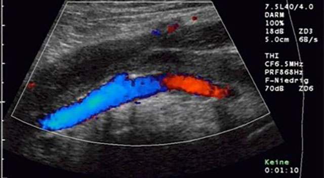 Vein Thrombosis