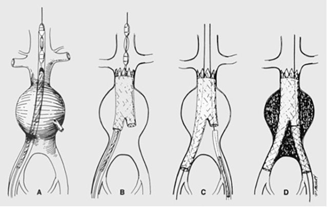 Endovascular Aneurysm Repair