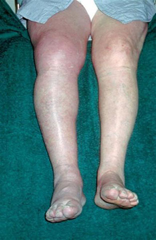 Vein Thrombosis