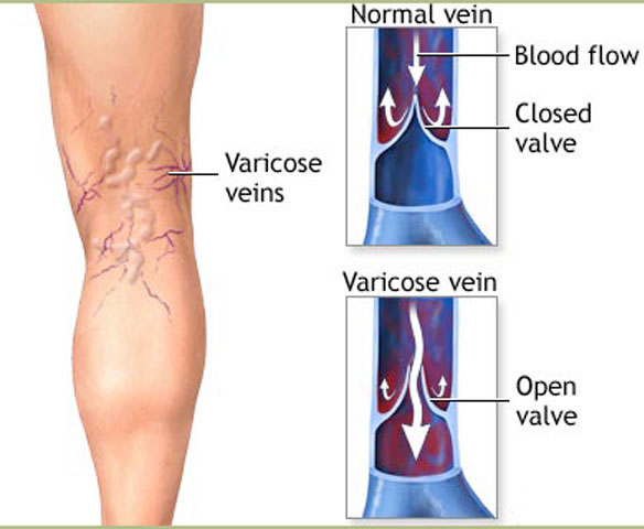 Varicose Veins in the Extremities - Causes