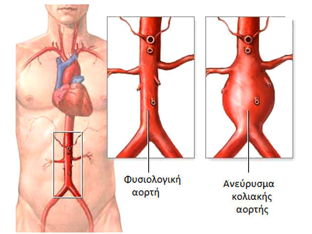 Abdominal Aortic Aneurysm