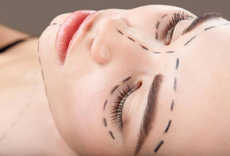 Ρυτιδεκτομή (Facelift)