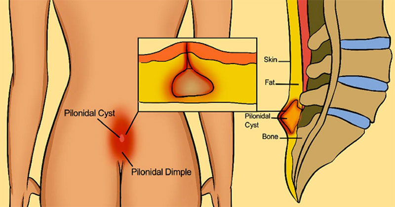 Pilonidal cyst, treatment