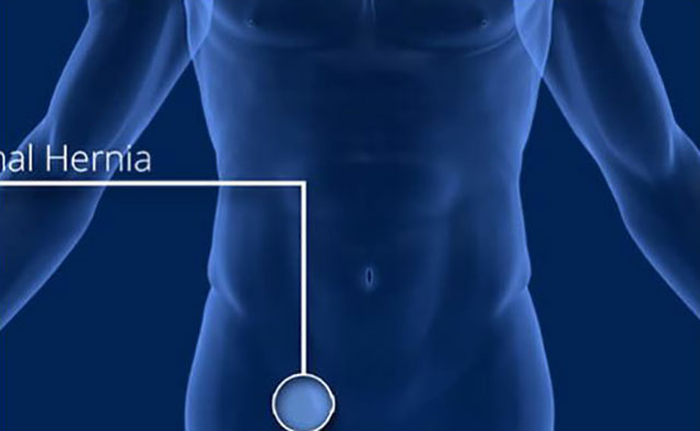 Inguinal hernia, laparoscopic method of repair