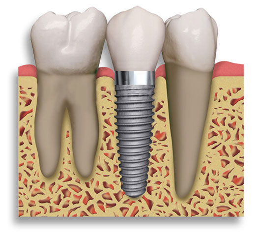Prosthetics, titanium implants
