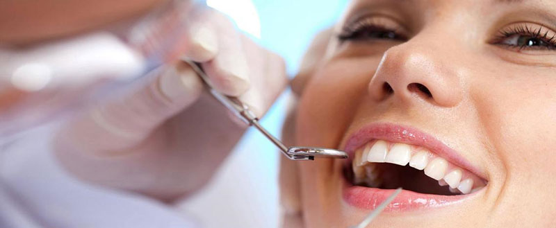 Veneers, resin veneers