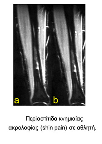 Tibial crest periostitis in an athlete