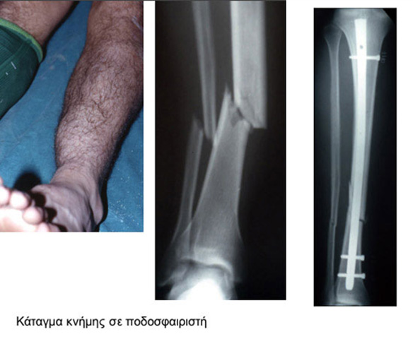 Tibia fracture in a football player