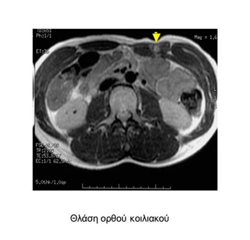 Rectus abdominis strain