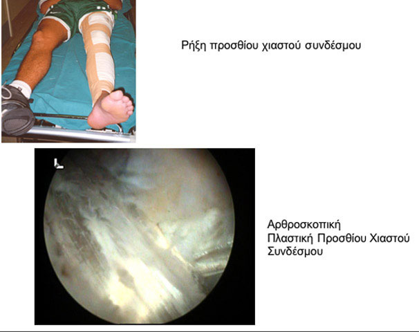 Anterior cruciate ligament rupture