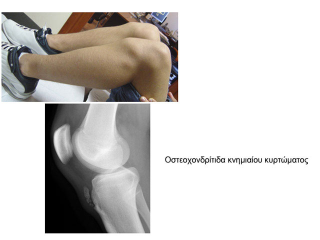 Osteochondritis of the tibial tubercle