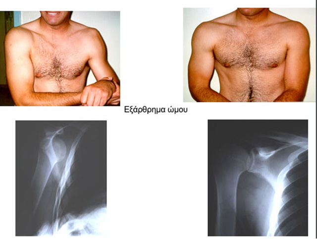 Dislocated shoulder