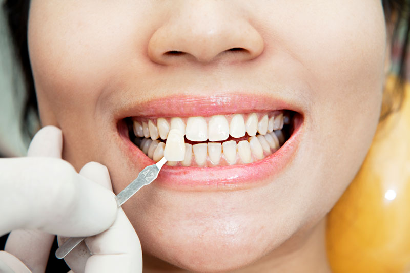 Porcelain Veneers
