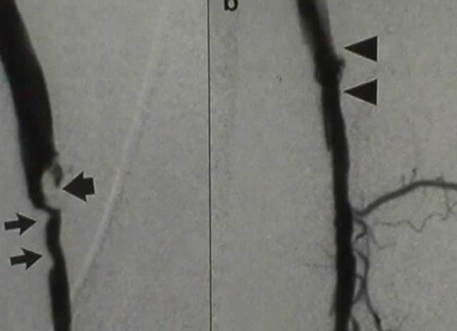 Angiography - angioplasty