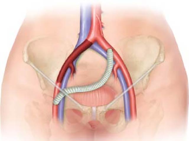 Aortoiliac bypass