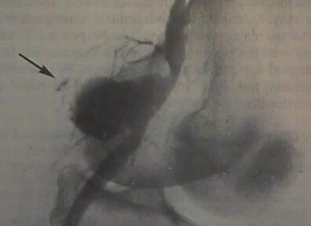 Popliteal artery aneurysm