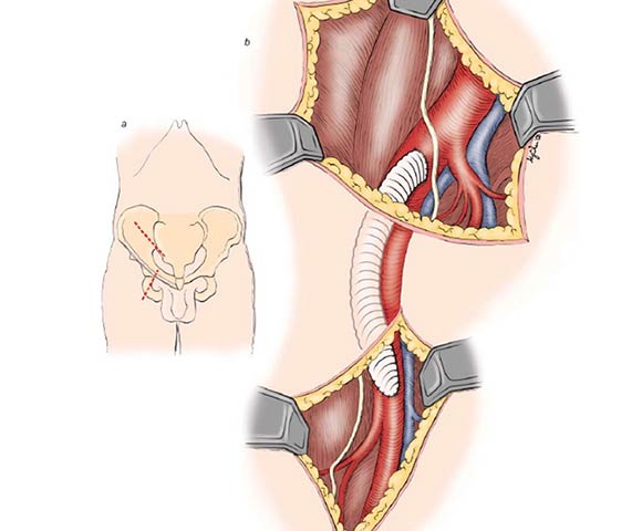Iliofemoral bypass