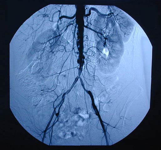 Aortoiliac occlusive disease angiography