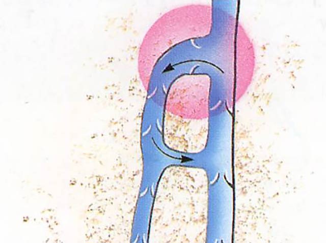 Veins - insufficiency of the central valve