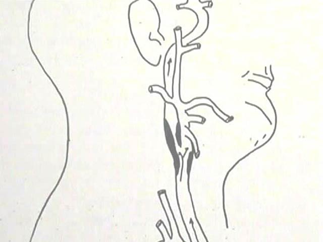 Carotid artery stenosis