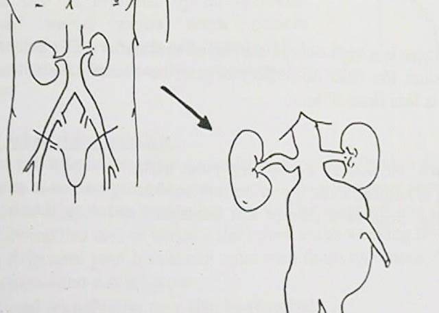 Aneurysm - AAA dilatation
