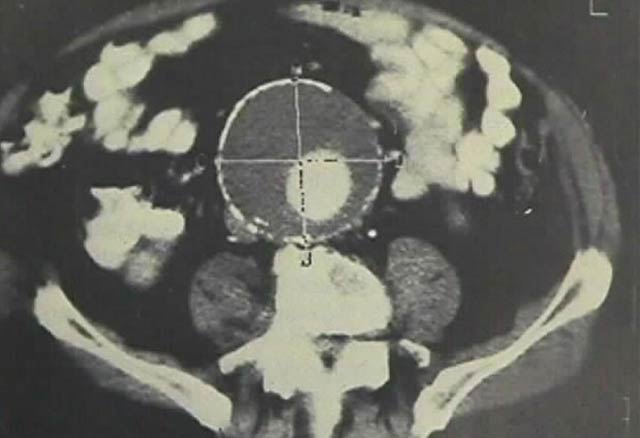 Abdominal aortic aneurysm
