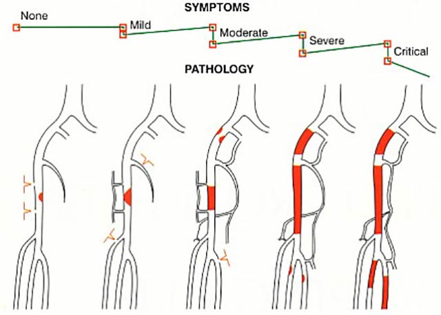 Intermittent claudication