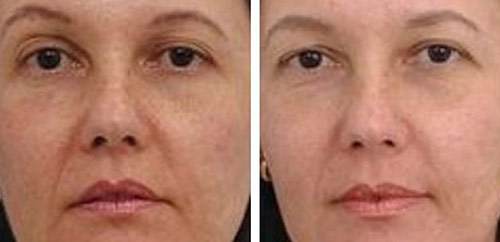 Facial relaxation