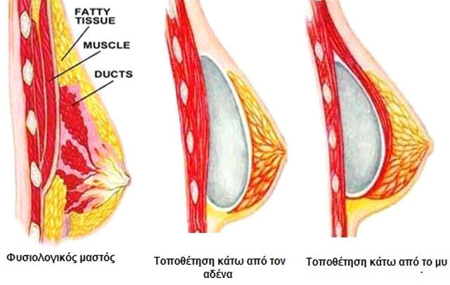 Breast augmentation