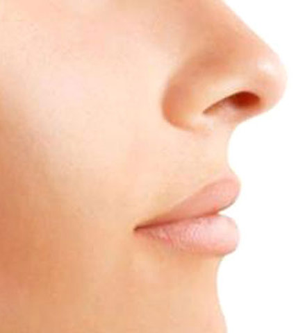 Rhinoplasty
