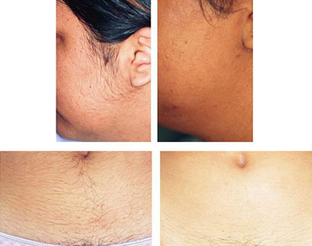 Hair removal