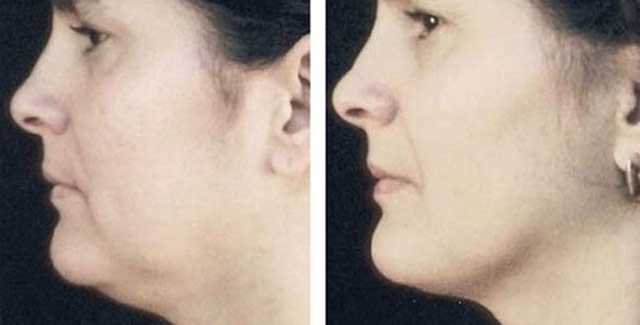 Smart Lipo
