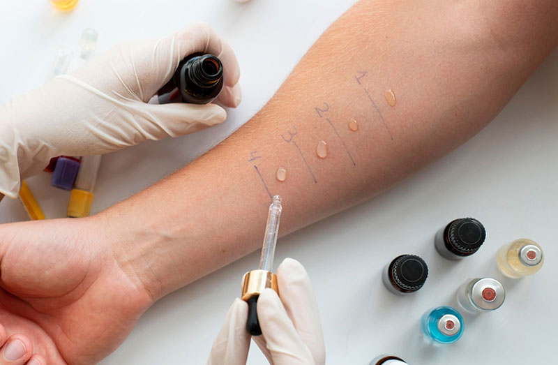 Δερματικές δοκιμασίες δια νυγμού (Skin Prick Tests)